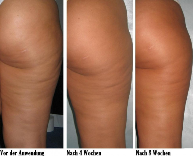 CELLULITE? SCHLAFFE HAUT? - Wellness Gesundheit - Freiburg