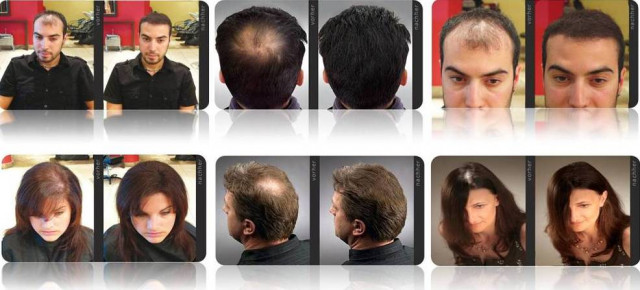 Lichtes Haar? Lichte Stellen? Dünnes Haar? Haarprobleme? Haarverlust? Haarausfal - Wellness Gesundheit - Unterensingen